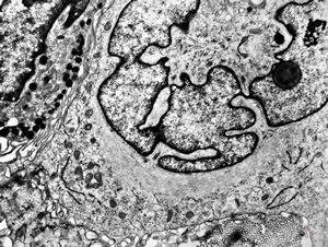 F, 49y. | myelosarcoma … histiocyte-like cells in dermal infiltrates F, 49y. | myelosarcoma … histiocyte-like cells in dermal infiltrates